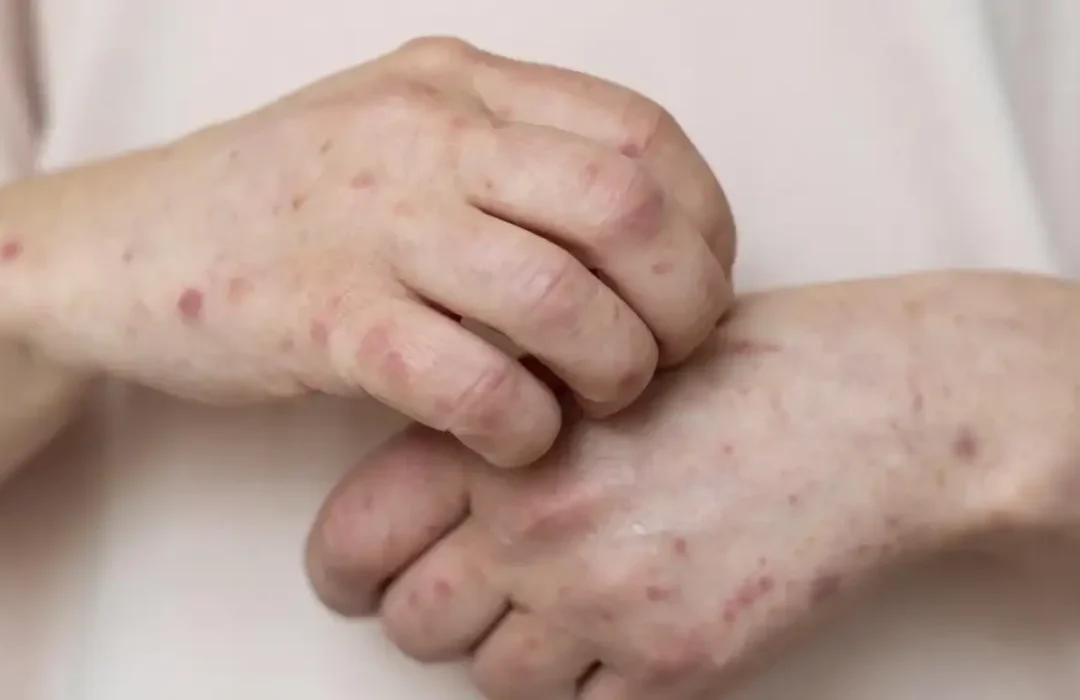 São Paulo registra mais quatro casos de sarampo e chega a 36 infecções em 2026